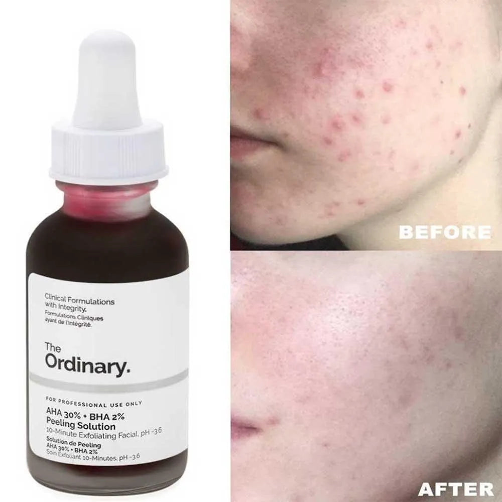 The Ordinary AHA 30% + BHA 2% Peeling Solution – Efecto Piel Nueva en Minutos